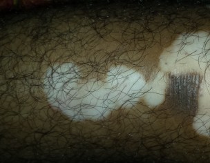 Skin Disease