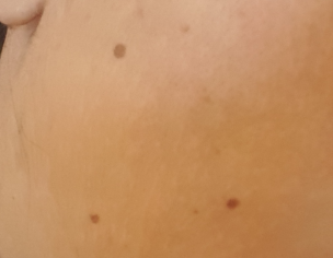 Skin Problm