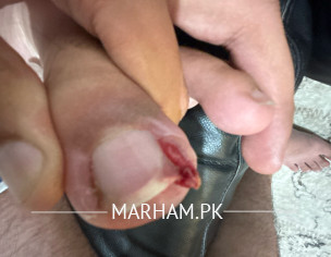 Toe Nail Infection 