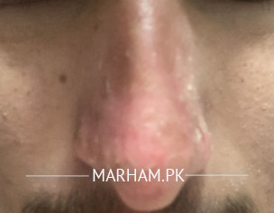 Sunburn On Nose