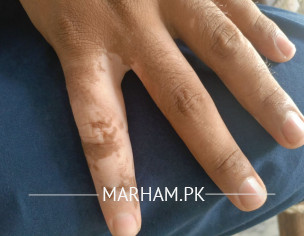 Vitiligo Developing