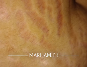 Skin Problem