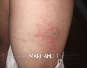 Insect Bite