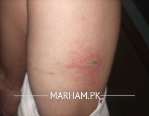 Insect Bite