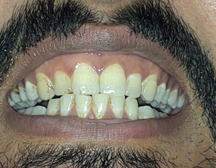 Dental Cavities