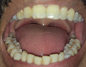 Dental Cavities