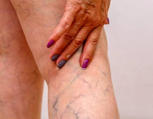 Thrombosis