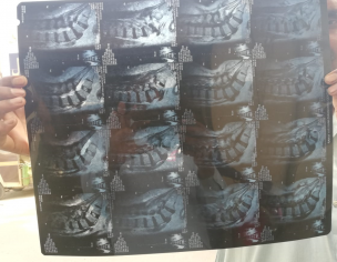 Spinal Stenosis