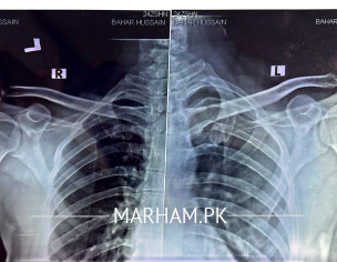 Shoulder Pain