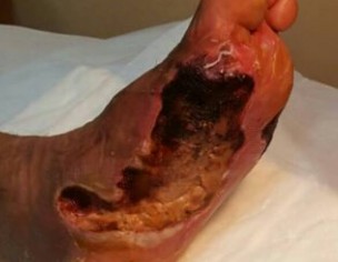 PROBLEM FOOT 