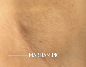 Armpit Lump