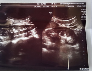 Polyuria Problem