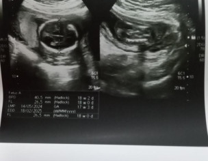 Lateral Ventricle Range 6mm