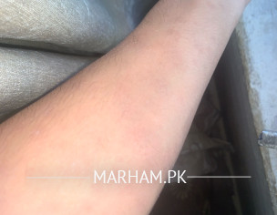 Marks After Chicken Pox