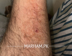 Marks On Leg