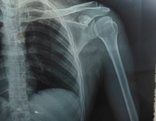 Shoulder Joint