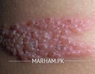 Small Water Blisters