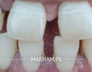 Gap Between Teeth