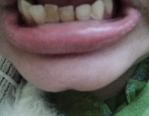 Teeth Gap