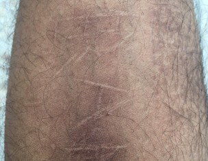 Self  Harm Scar