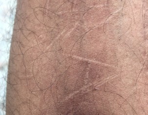 Self  Harm Scar