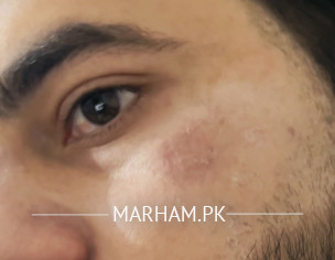 Laser Burn Removal 