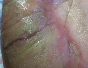 Skin Issue