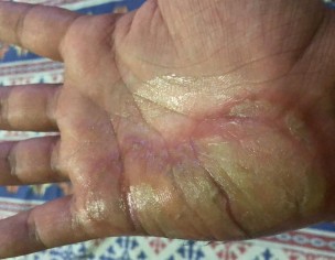 Skin Issue