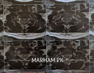 Cervical Spine
