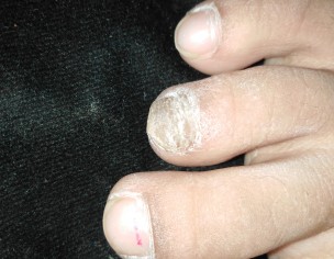 Nail Problem