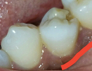 Teeth Pain By Hitting Fish Bone.