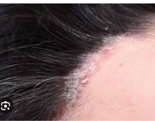Sebborhic Dermatitis