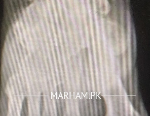 Ankle Problem