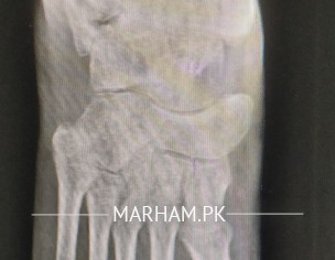 Ankle Problem