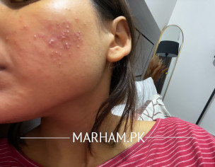 Acne Flare Up 