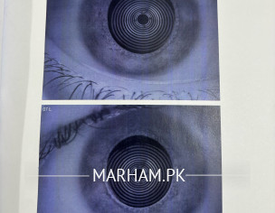 Dry Eyes Analysis