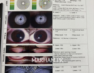 Dry Eyes Analysis