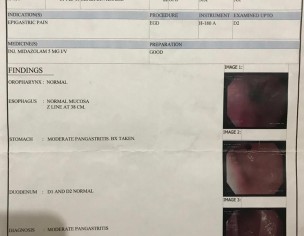 Moderate Gastritis