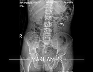 Spinal Disc Problem