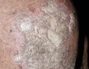 Skin Problem