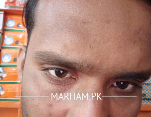 Forehead Issue