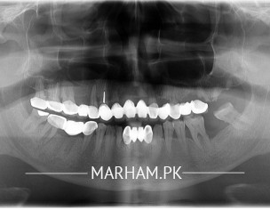 Dental Implants 