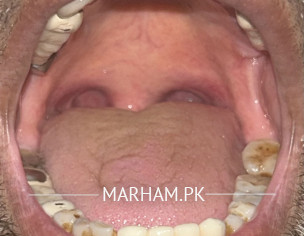 Dental Implants 