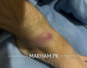 Infected Wound 