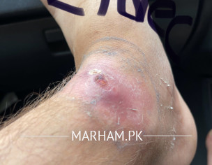 Infected Wound 