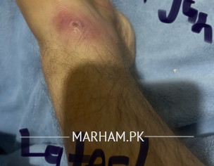 Infected Wound 