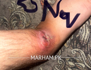 Infected Wound 