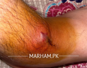 Infected Wound 