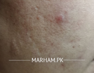 Acne Problem