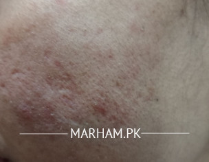 Acne Problem